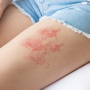 Herpes Zoster am Bein