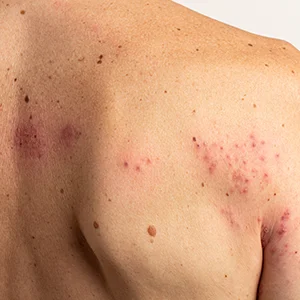 Gürtelrose am Rücken mit streifenförmigem, einseitigem Bläschenausschlag