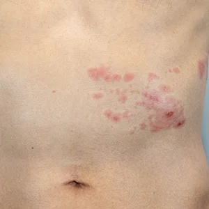 Halbseitiger Gürtelrose-Ausschlag am Bauch mit gruppierten Bläschen
