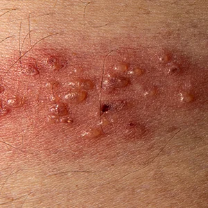 Entwicklung Herpes Zoster von der Rötung über Bläschenbildung bis zur Krustenphase