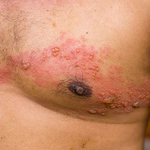 Typischer einseitiger Gürtelrose-Ausschlag mit gruppierten Bläschen entlang eines Dermatoms am Brustkorb